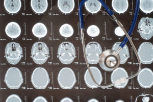 Signs of a traumatic brain injury