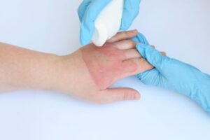 Burn Injury Statistics in Bucks County, Pennsylvania: What the Numbers Reveal