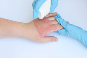 Treating Burn Injuries Cumberland County Pennsylvania's Top Hospitals and Specialists
